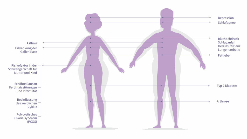 Grafik über die Begleiter von Übergewicht.